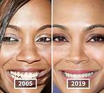Has Zoe Saldana Received a Nose Job? the Untold Truth! ·