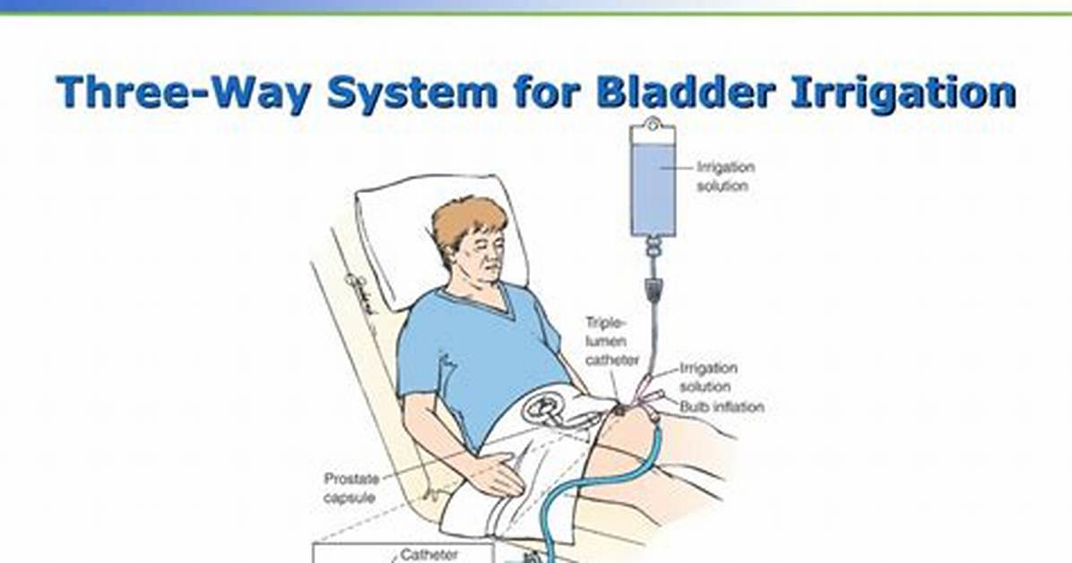 How Do You Irrigate a 3 Way Foley Catheter?
