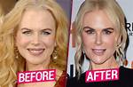 Is Nicole Kidman's Plastic Surgery a Good or Bad Thing?