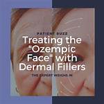 Lupus and Taking Ozempic: Understanding the Connection