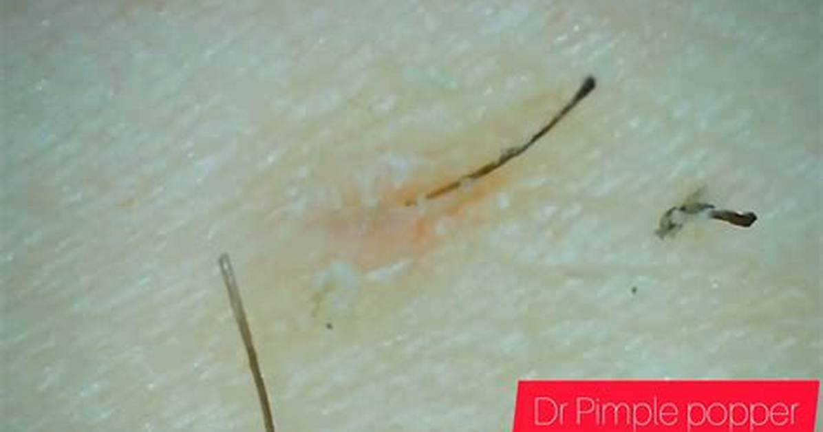 The 10 Gnarliest, Most Pus-Filled Popping Videos of 2017