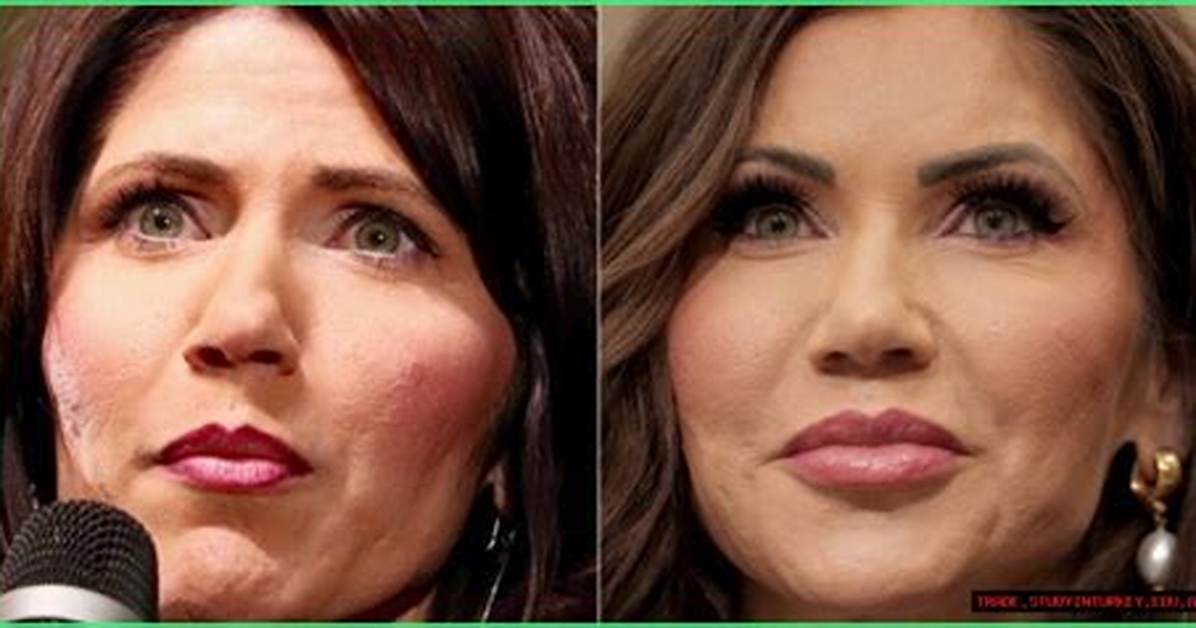 The Ultimate Guide to Kristi Noem Filler: from Procedure to Results