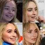 Unveiling the Transformation: Sabrina Carpenter Before Lip Filler